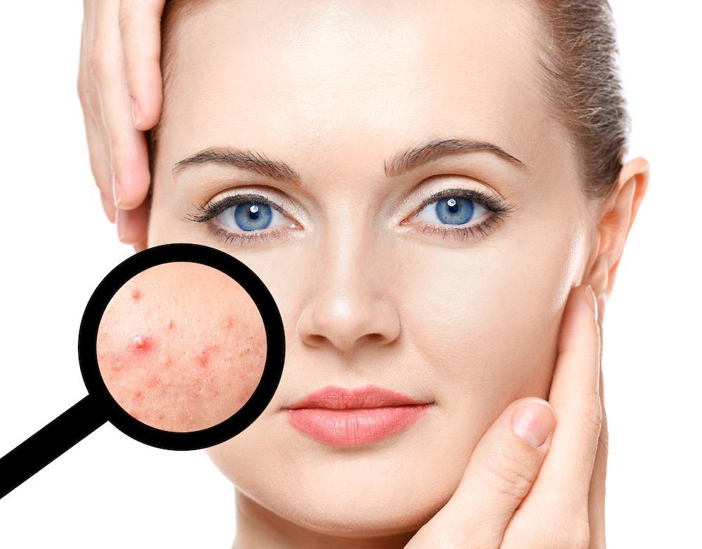 How to cure a pimple overnight?