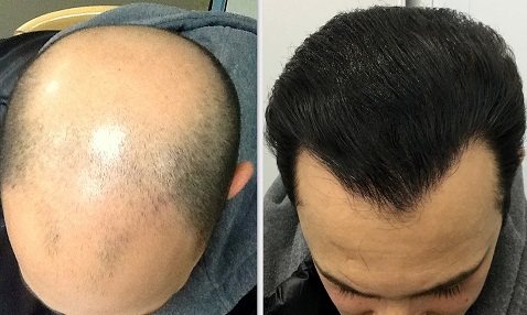 Best Hair Transplant in Lahore Comprehensive Guide & Top Clinics