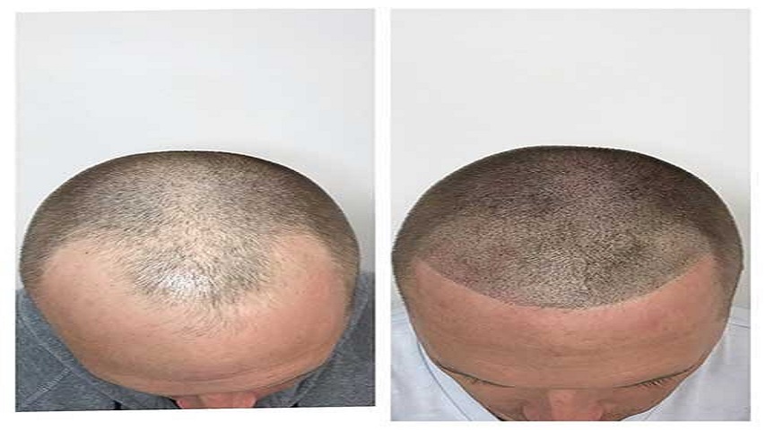 Thicker Tresses, No Surgery: Non-Invasive Treatments for Hair Thinning