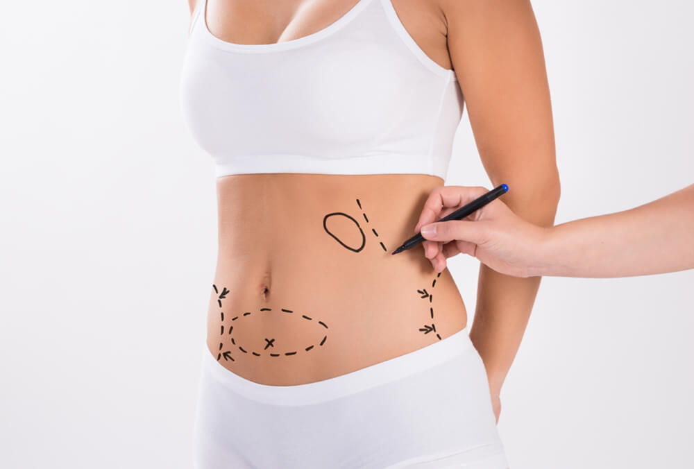 Things to Consider Before Getting Liposuction in Dubai