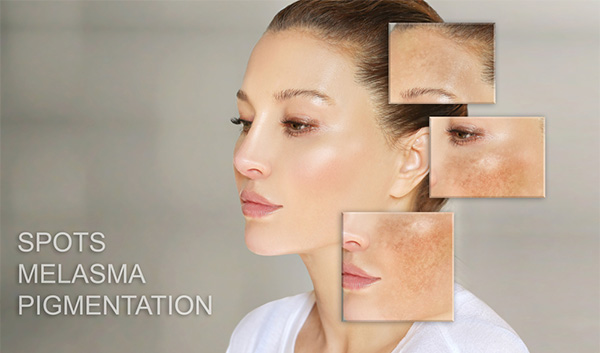 Can you treat melasma permanently?