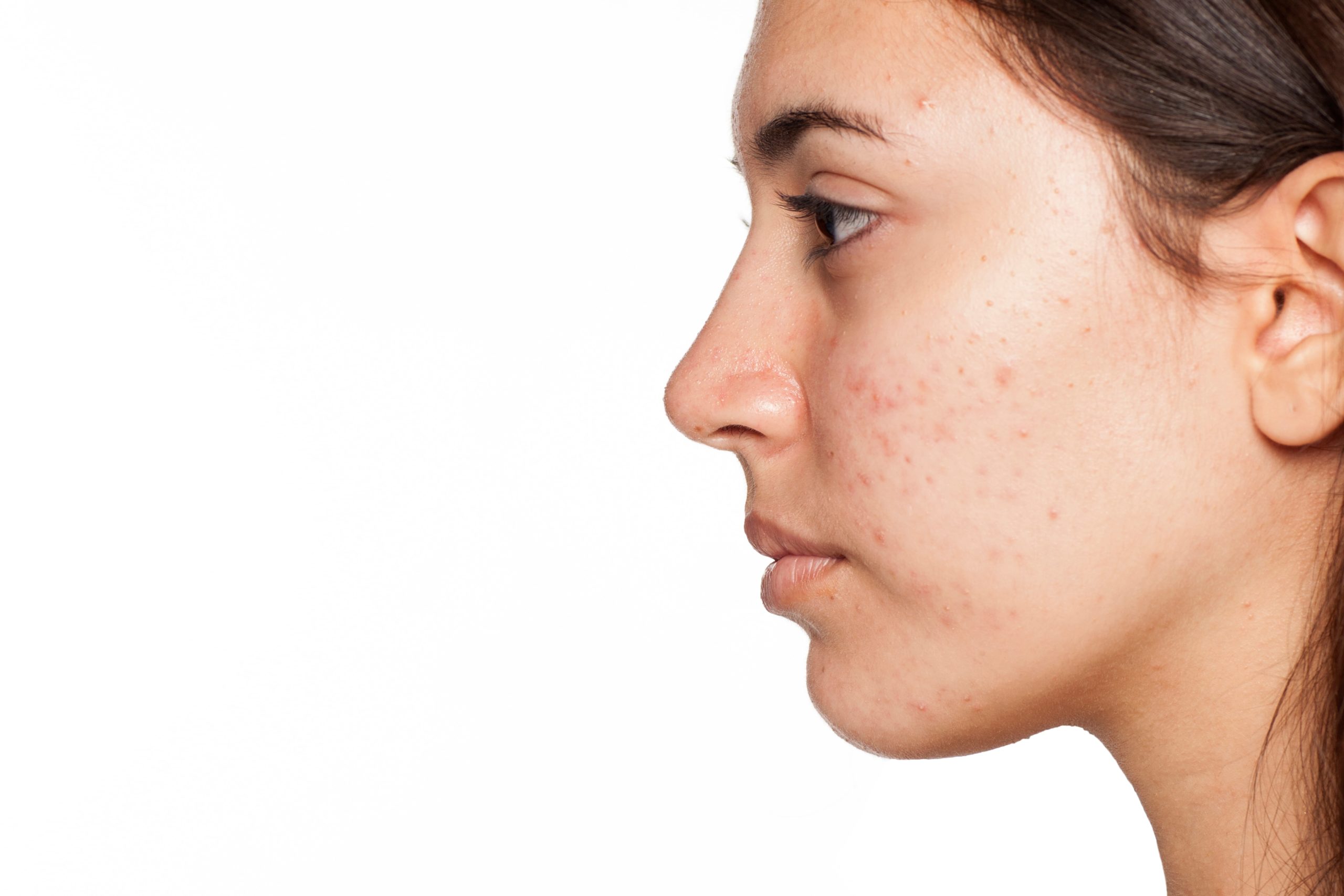 Isotretinoin: Improving Skin Clarity and Promoting Radiant Skin