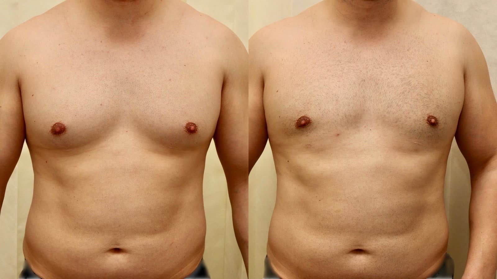 Understanding Gynecomastia and Its Impact, Treatment and Cost