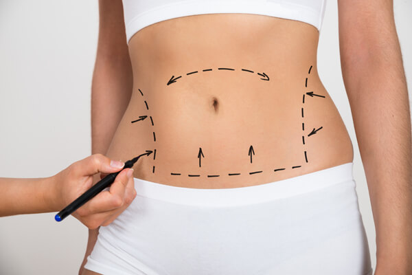 Liposuction: What You Should Know