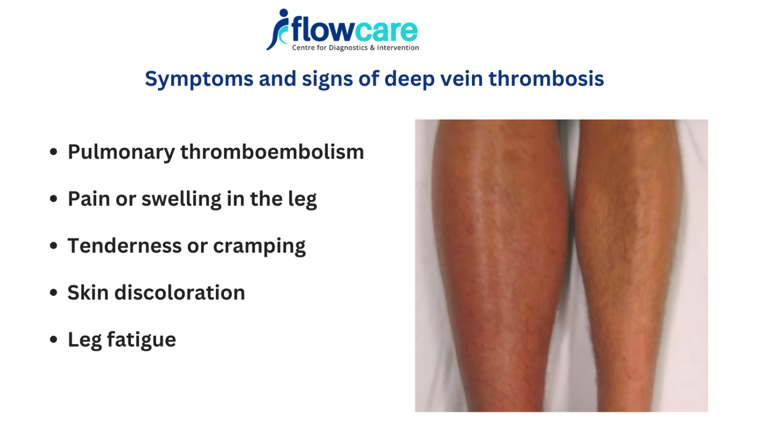 Understanding Deep Vein Thrombosis Symptoms: A Comprehensive Guide by Flowcare